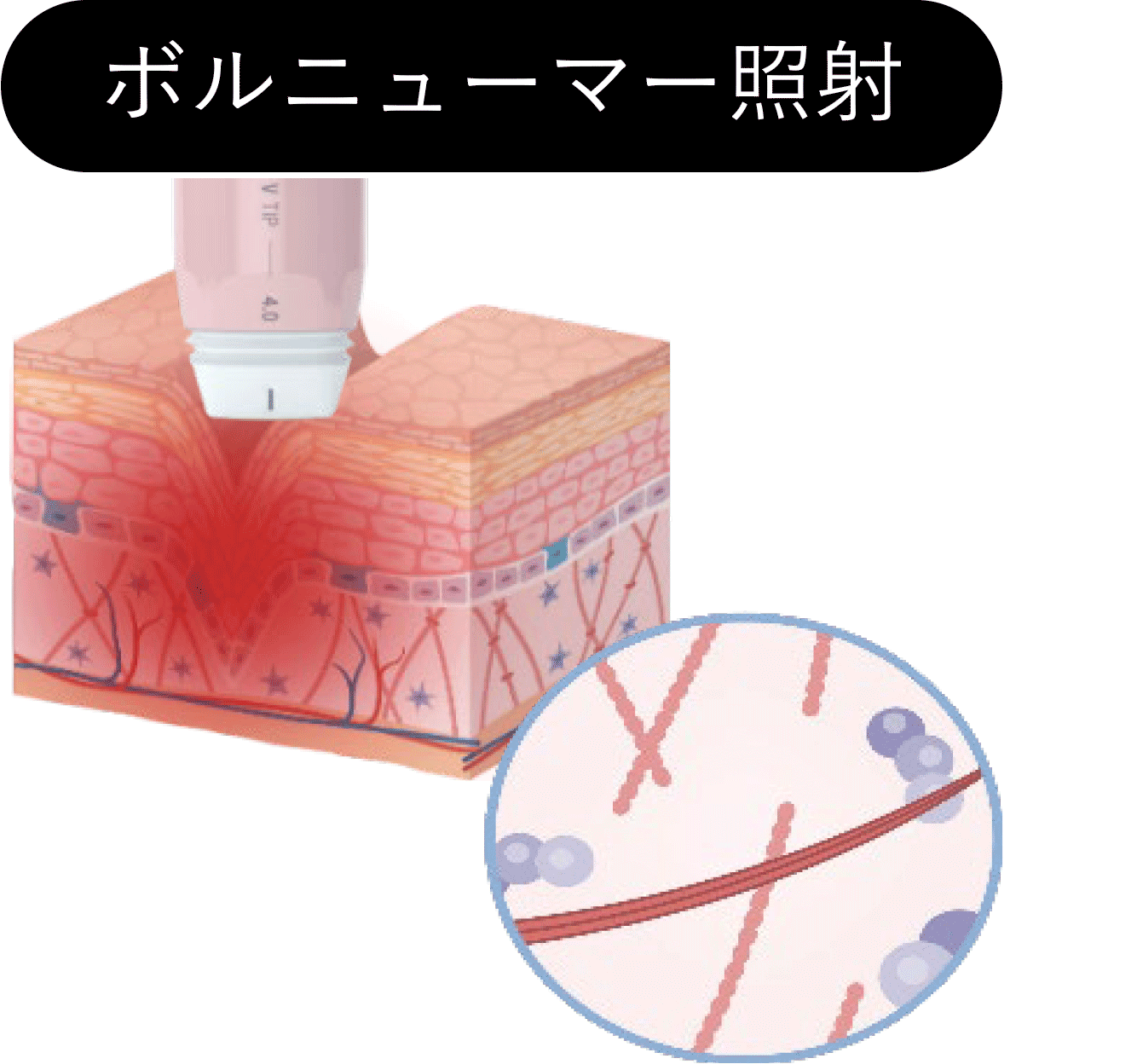 ボルニューマー照射